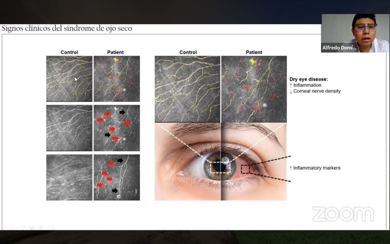 En este momento estás viendo Experto habla sobre interacción de células neuroinmunes con dolor ocular