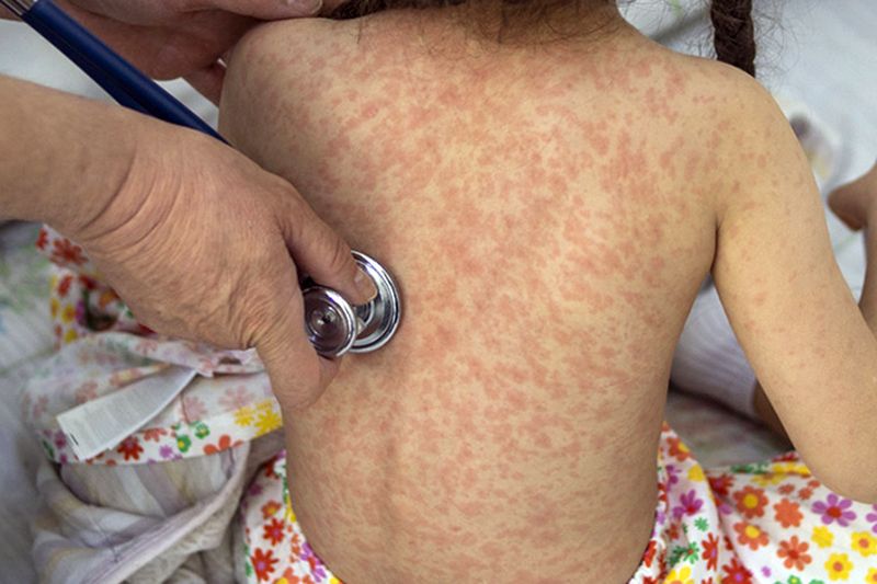 En este momento estás viendo En Tecomán, primer caso en Colima de sarampión en niña de 2 años