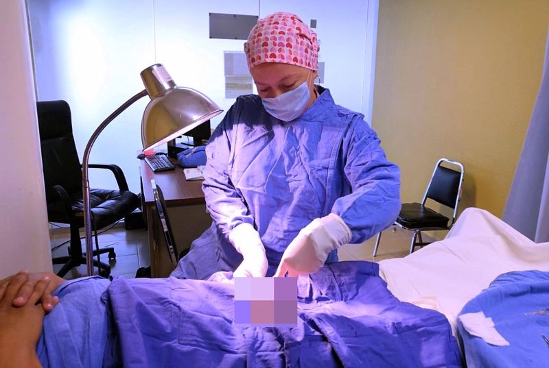 En este momento estás viendo Vasectomía sin bisturí ofrece una opción anticonceptiva permanente para los hombres